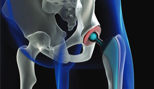 Hip replacements for the under 55